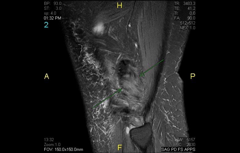 Figure 3 for case Popliteus tendinosis